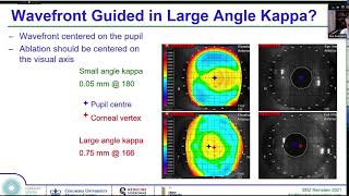 Choosing From TransPRK LASIK Wavefront Topography SMILE ICL