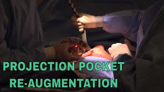 Projection Pocket Re-Augmentation Surgical Procedure with Dr. A