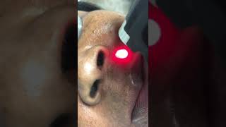 Laser hair removal on upper lip of African American female