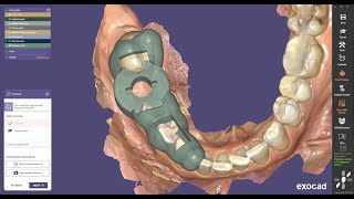 How to Design an Implant Drill Guide in ExoPLAN Guide Creator - IDDA MiniBytes Tutorials