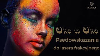 Oko w oko z laserem frakcyjnym - pseudowskazania | L'Experta