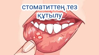 Стоматиттең тез құтылу үшін не істеу керек?!