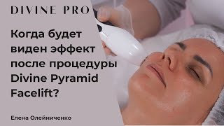 Когда будет виден эффект после процедуры Divine Pyramid Facelift?