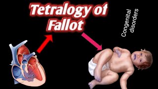 tetralogy of fallot