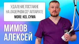 Лечение постакне на CO2 лазере More-Xel CYMA