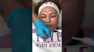 Dermapen Tedavisi / Love Beauty Center