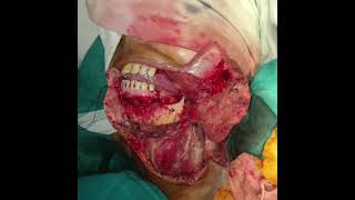 FREE RADIAL ARTERY FOREARM FLAP FOR BUCCAL MUCOSAL DEFECT. LONG TERM OUTCOME.