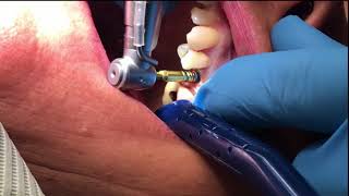 Implant Video