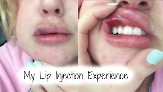 THE UGLY TRUTH ABOUT LIP INJECTIONS | My Experience