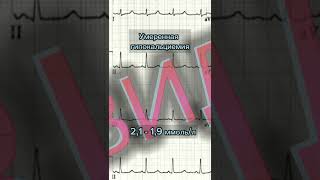 #Гипокальциемия  #ecg #экг #shorts