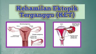 Mengenal Kehamilan Ektopik Terganggu (KET)