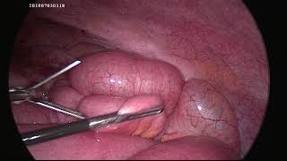 Laparoscopic surgery for intestinal obstruction due to Interbowel adhesions  after LSCS