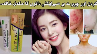 How to use Fair and clear cream for Best Results|Fair and clear Anti Acne cream review|Honest Review