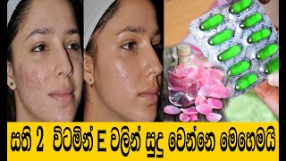 සති 2 න් විටමින් E වලින් සුදු වෙන්නෙ මෙහෙමයි | Apply Vitamin E oil on my Face |  Sudu wenna Rahas