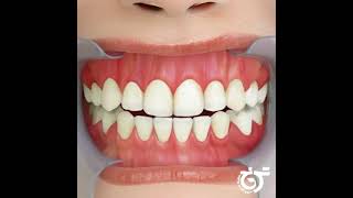 کشیدن دندان در ارتودنسی | ارتودنسی در تهران | دندانپزشکی ترنج یا unique smile