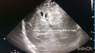 Peri ventricular hemorrhagic infarction( L) with midline shift