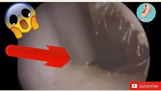 Microsuction of Earwax from both ears​#clip3