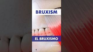 BRUXISMO DENTAL - Efectos en dientes y músculos