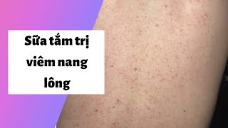 5 loại sữa tắm đặc trị viêm nang lông tốt, hiệu quả nhất | Kèm Giá Bán