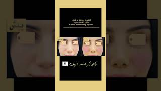 کۆنتووری ڕوومەت بە فیلەر- كونتور الخدود بالفيلر‏-Cheek  contouring by filler—————————————————————