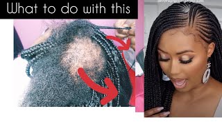 Alopecia treatment/But What next? Do you have alopecia and your worried 😟 How to braid such hair