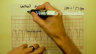 ECG/EKG interpretation (basics) COURSE Part 2 of 3 ~  12 lead ECG analysis.