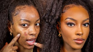 How to Cover Up Acne Blemishes and Active Acne!