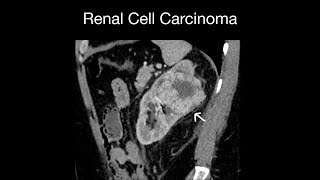 Renal Cell Carcinoma Case 11