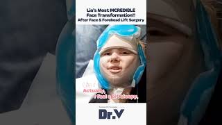 [SHORTS] Facelift in Korea Plastic Surgery Clinic #shorts