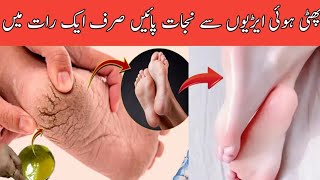 How to treat cracked heels at home|cracked heels removal|cracked heels