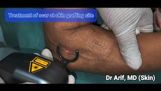 Laser scar treatment after skin grafting @DrArifMDDermatologist  #scartreatment #burnscar