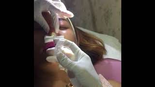 0811 1721 280, Filler hidung dekat Pangadegan Rinanda  Skin Care Center