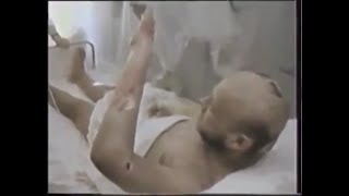 People affected by radiation during Chernobyl disaster*Radiation sickness