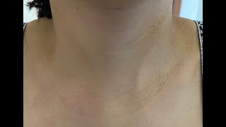 Izsiz kəsiksiz Endoskopik tiroidektomiya (Zob əməliyyatı) / Endoscopic Thyroidectomy- ABBA