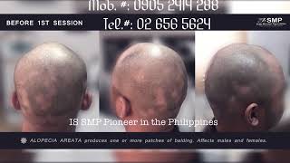 Scalp Micro Pigmentation Manila not Ordinary Hair Tattoo