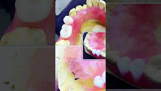 OMG! You Won't Believe These Dentures! #FlawlesslyNatural -#shortvideo #fypシviral #dentalcare