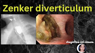 208.Zenker Diverticulum  #zenker's diverticulum #pharyngealpouch #anatomylectures