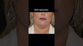 Neck Lip | McCormack Plastic Surgery