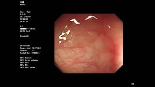 [Sample video]  1st trial Fail Case T010.,  Total colonoscopy : no cap OLYMPUS 290 + CF-H260AL