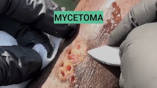 Mycetoma-fungal infection of foot @DrArifMDDermatologist  #footinfection