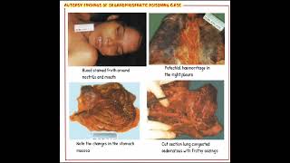 Autopsy In Case OP Poisoning Forensic Medicine & Toxicology