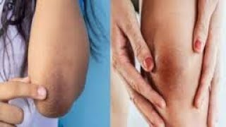 गर्दन, कोहनी,घुटने और हाथ पैर के कालेपन को साफ करने का घरेलू उपाय। Homemade Skin Tanning Removal