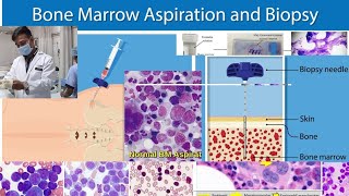 Bone Marrow Aspiration and Biopsy.|| BMA || BM Trephine Biopsy || BM Touch Imprint .