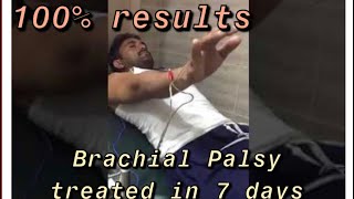 Acupuncture for Brachial Palsy