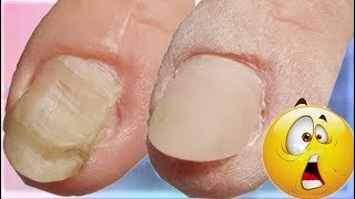 DEFORMIERTER Nagel durch VERLETZUNG??😱😱Rekonstruktion eines Nagels #nagelverletzung,