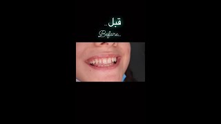 شاهد ابتسامة مريضتنا قبل وبعد إجراء ابتسامة هوليود باربع عدسات فقط  #ابتسامةهوليود #ابتسامةالمشاهير