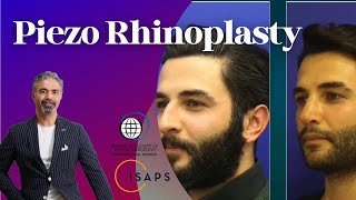 Piezo Rhinoplasty Nedir? Laser Rhinoplasty Nedir? Micro Rhinoplasty Nedir ? #piezo #rhinoplasty