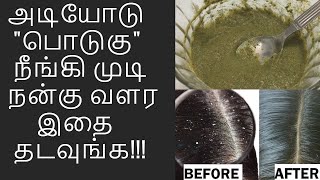 🎯பொடுகுத் தொல்லைக்கு இந்த 3 பொருள் போதும்/ #podugu #dandrufftips #dandruff #homeremedy