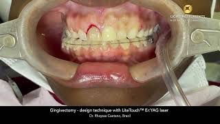 Gingivectomy - design technique with LiteTouch™ Er:YAG laser