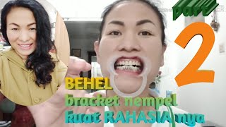 TUTORIAL cara Pasang behel bracket sendiri part 2